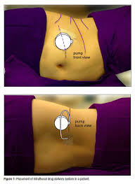 Image result for Intrathecal Pump