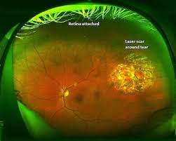 No content on this site, regardless of date, should ever be used as a substitute for direct medical. Floaters Retinal Tears And Retinal Detachments Visionaware