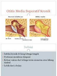 Otitis media, fotoğraf ve şemanın genel resmi. Otitis Media Supuratif Kronik