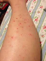 Aswell as having ingrown hairs i have really bad scars and even though i have shaved it still looks like i haven't due to these scars. Ingrown Hair Scars On Legs From Picking Ingrown Hairs