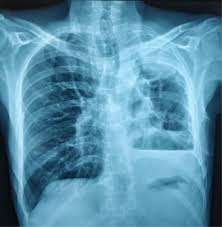 Thirteen patients (68.4%) were misdiagnosed as pneumonia, lung cancer and tuberculosis initially. Squamous Cell Carcinoma In The Post Tuberculosis Lung After 30 Years Of Treatment Completion