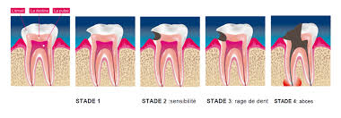 Elles forment un enduit sur les dents. Dentiste Arras La Maladie Carieuse Risque En Cas De Non Traitement