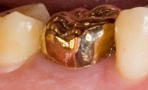Lil wayne no teeth vine | nicki minaj teeth before. Gold Teeth Wikipedia