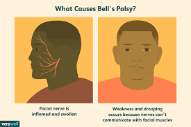 Signs and symptoms of bell's palsy. Bells Palsy Overview And More