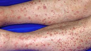 Image result for allergy rash on the legs