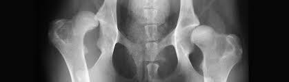 Osteosarcoma (bone cancer) is a common cancer in our dogs, and it usually develops in the long bones of the legs and the ankle or hock joint. Hip Dysplasia In Dogs