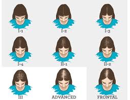 Male pattern hair loss is inherited and typically starts from about age 30. Difference Between Male Pattern Hair Loss And Female Pattern Hair Loss