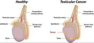What are the symptoms of testicular cancer? Testicular Cancer Treatment Services In New Jawahar Nagar Jalandhar Bhargava Hospital Id 20020376473