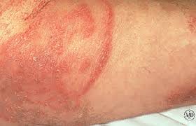 Image result for itchy skin rectum