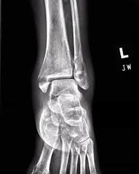Image result for Ankle XRay