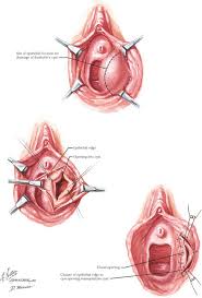 Image result for Bartholin's gland abscess