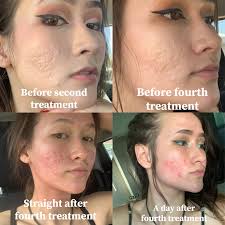 Skin Concern Has Anyone Done Microneedling And Not Seen Results I M Feeling Like My Skin Isn T Responding To Treatment More Info In Comments Skincareaddiction