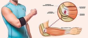 If your tennis elbow hasn't improved after a year or more of trying various treatments, your doctor may suggest you have surgery. Tennis Elbow A Orthopaedics Sports Med Center New Delhi