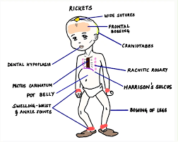 Image result for Craniotabes