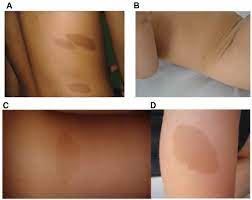 May be a sign of neurofibromatosis type 1 if a child has 6 or more spots; Cafe Au Lait Macules And Associated Genetic Syndromes Journal Of Pediatric Health Care