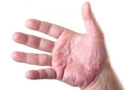 While psoriatic arthritis symptoms vary from person to person, they commonly affect skin and joints. Psoriatic Arthritis Pictures Of Symptoms And Progression