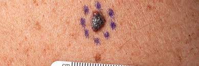 Skin cancer shows up in a number of blood tests. Researchers Developing A Blood Test For Melanoma Lab Tests Online