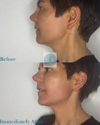 ✨ Say goodbye to summer-clogged pores! ✨ Sweat, sunscreen, and heat can  leave your skin feeling congested and dull after summer ☀️. Our HydraFacial  pain-free extractions gently clear away dirt, oil, and