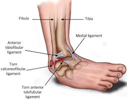 If you had vision that could see internally you would not see and visible damage to the ligament, but the damage would exist on the microscopic level in the form of tearing of some of the structures that compose the. Ankle Sprain Recovery Time Symptoms Causes Treatment Plan