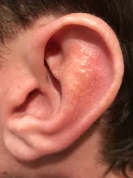 Is this an std, or just a result of too much friction? Herpes Simplex Virus Infection Of The External Ear Infectious Diseases