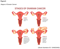 The 2 systems used for staging ovarian cancer, the figo (international federation of gynecology and obstetrics) system and the ajcc (american joint committee on. Ovarian Cancer For Rns And Lpns Nursing Ce Course Nursingce