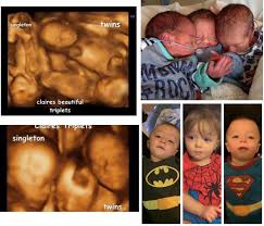 Triplets 3d Scan Images And Born Baby S Triplets Image The Incredibles