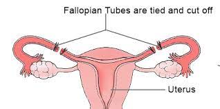 Long Term Birth Control Women S Group Of Northwesternwomen S Group Of Northwestern