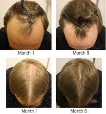 Premature graying is defined as loss of hair pigment that occurs before the age of 20 in caucasian people, before the age of 25 in asian people and before the age of 30 in african people, according to a june 2017 review in pigment international. Prevent Male Hair Loss Before It S Too Late Male Hair Loss Solution