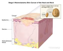 Symptoms of lymph node cancer include: Skin Cancer Types Symptoms Information Dana Farber Cancer Institute Boston Ma
