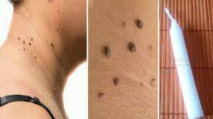 شمعة واحدة معجزة في في علاج الثآليل و الزوائد الجلدية ستقضي عليها و تختفي للأبد youtube fitbit flex tattoos flex