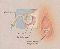 Bartholin Duct Cyst And Gland Abscess: Office Management | Aafp