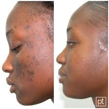 Skin Care Company & Acne Skin Care Products in the Bahamas | Perfec-Tone