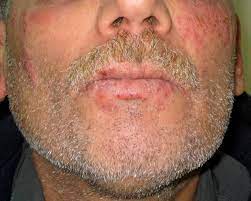 Doctors hook & handsfield, i have what seems to be a very stubborn & problematic issue with hsv2 on my face. Disseminated Primary Hsv 2 Infection Of The Face