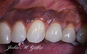 What Can Be Done About Brown Or Black Areas On The Gums Julie M Gillis Dds