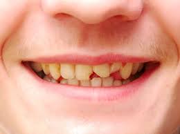Why Teeth Are Yellow Even Though You Brush Them North Shore Dental Group