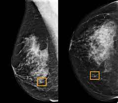 Watch video to see what it's like to have a mammogram, or breast cancer detection exam. A I Is Learning To Read Mammograms The New York Times