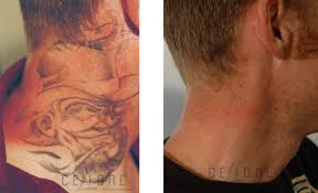 Tattoo inks tend to be made of compounds from heavy metals. How Does Laser Tattoo Removal Work