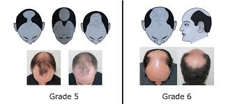 Hair loss is treated medically and/or surgically. Grade 5 6 Hair Loss Maral Hair