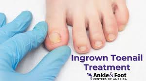 Image result for Toenail Removal