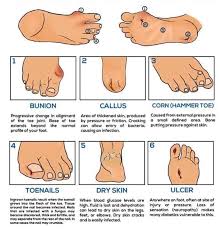Image result for diabetic toes