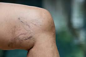 Ada beberapa cara untuk mengelakkan vena varikos. Cara Menghilangkan Varises Mulai Cara Alami Hingga Medis Lifepack Id