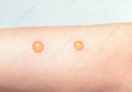 Image result for flea bites