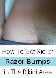 They get big and painful and pop. How To Get Rid Of Ingrown Hair Scars Bikini Line Ingrown Hair