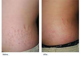 Stretch marks aren't painful or harmful, but some people don't like the way they make their skin look. Stretch Marks Treatment Tampa Bay St Petersburg Fl