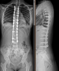 O ângulo de curvatura da coluna vertebral. Cirurgia De Escoliose Medico Especialista Em Coluna Dr Alberto Gotfryd