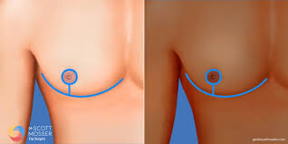 Image result for Nipple Inversion