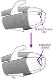 Image result for icd 10 code for rtc tear