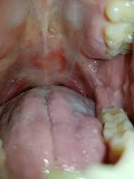 Image result for Physical injury red spots roof of mouth