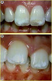 White Spot Lesions Formation Prevention And Treatment Seminars In Orthodontics