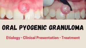 Image result for granuloma gum disease